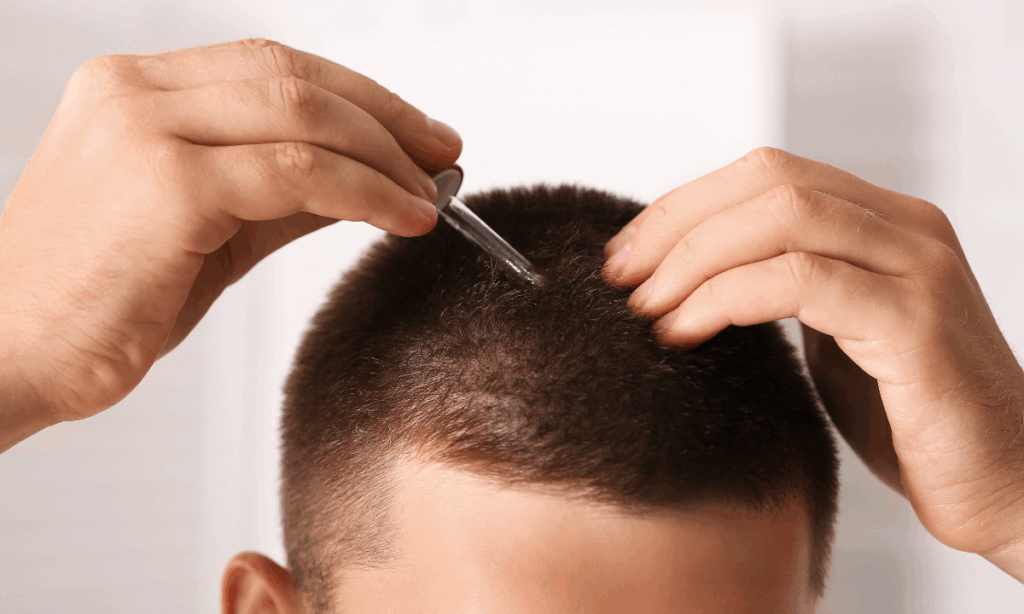 Best Minoxidil + Finasteride Topical Solutions
